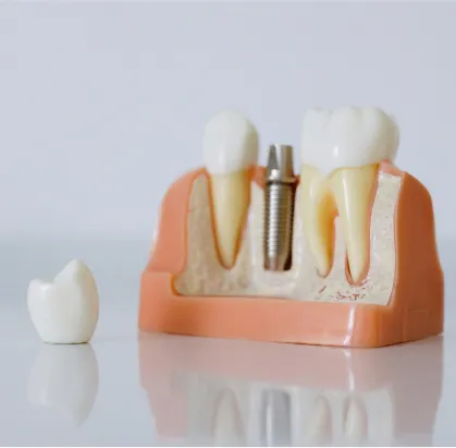 Implantes Dentales
